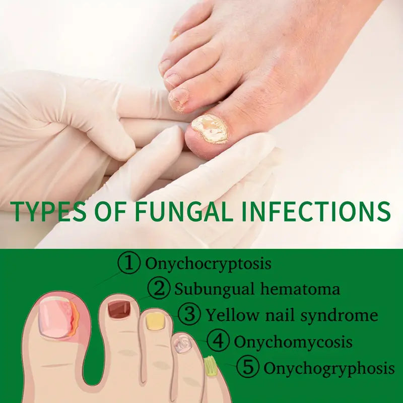 Ginger Nail Care Liquid Onychomycosis Fungus Repair Hand and Foot Nail Care Clearance Wide Range Of