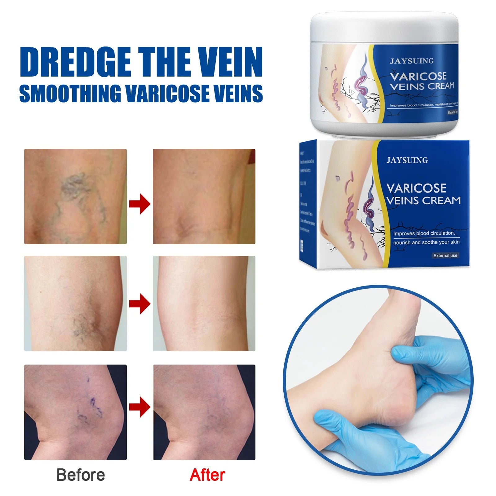 Pain Relief Leg Spider Veins Vasculitis Promote Circulation Smooth Metabolism 30g Exfoliation Cheap Best Store To Get