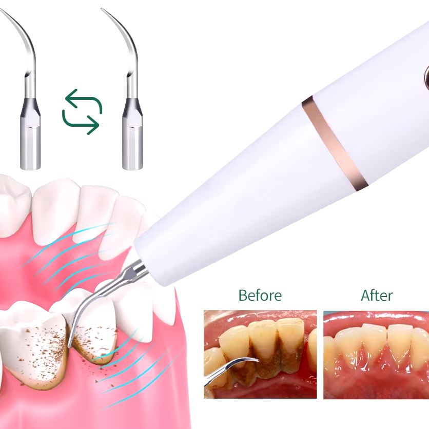 Advanced Electric Teeth Cleaning Tool Powerful Calculus Remover & Tartar Eraser Sale Authentic