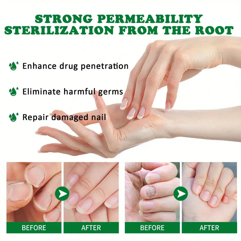 Ginger Nail Care Liquid Onychomycosis Fungus Repair Hand and Foot Nail Care Clearance Wide Range Of