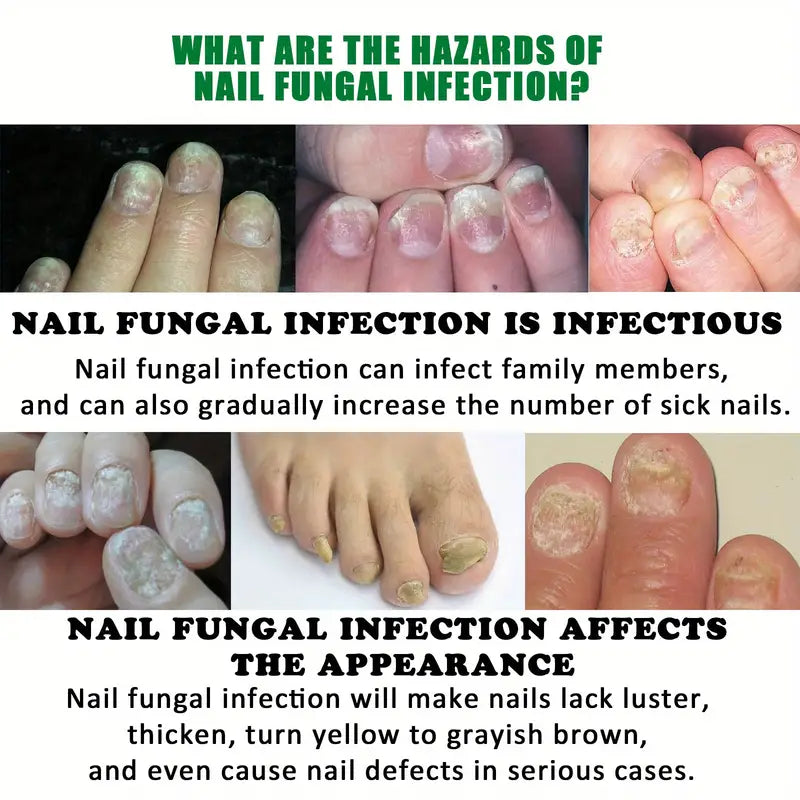 Ginger Nail Care Liquid Onychomycosis Fungus Repair Hand and Foot Nail Care Clearance Wide Range Of