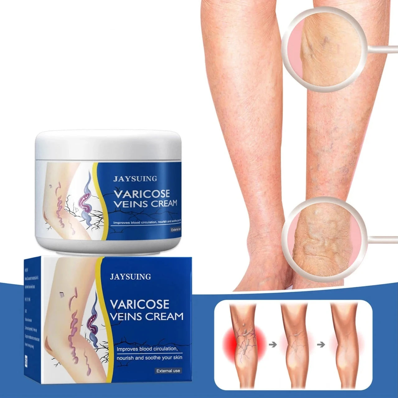 Pain Relief Leg Spider Veins Vasculitis Promote Circulation Smooth Metabolism 30g Exfoliation Cheap Best Store To Get